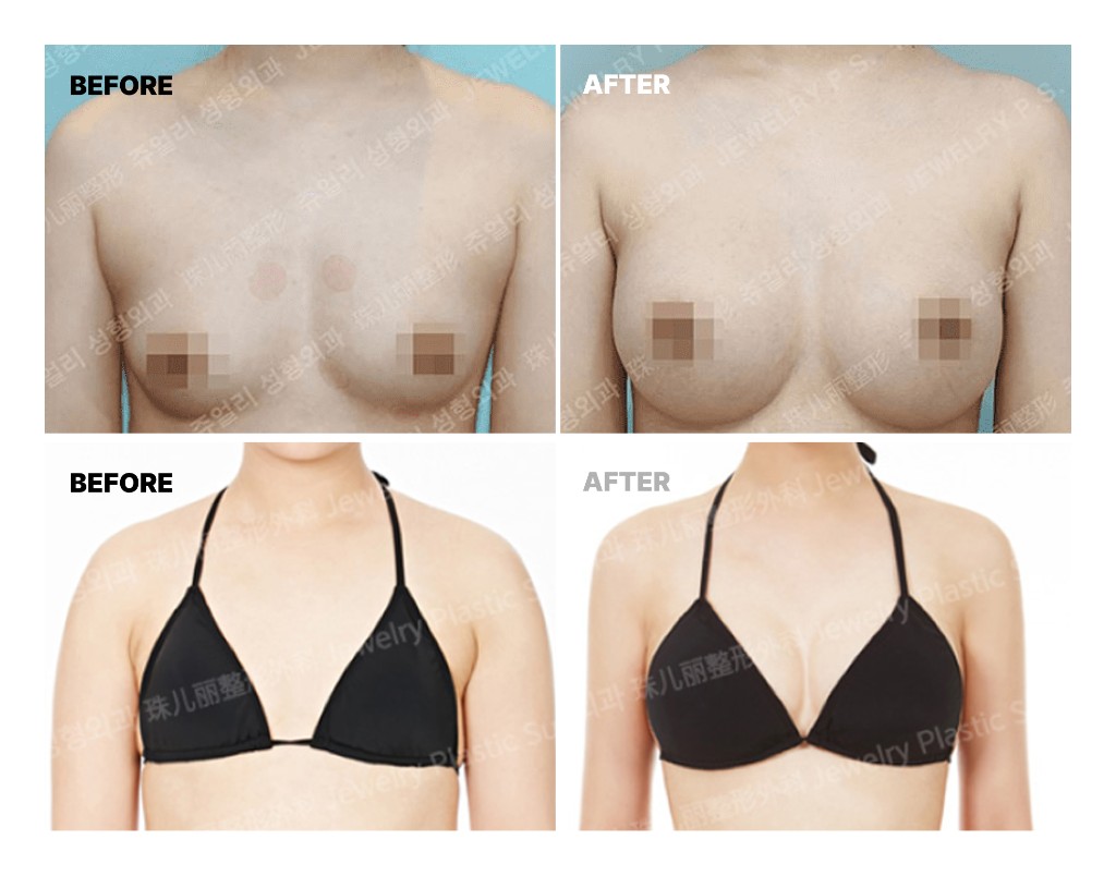 가슴 수술 전후 참고 이미지. 전·후 비교가 두 가지 사례로 포함되어 있습니다.