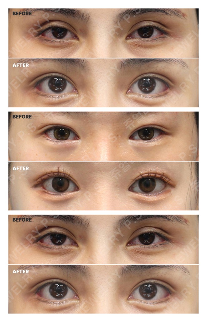 눈 성형 전후 참고 이미지. 전·후 비교가 한 장에 포함되어 있습니다.