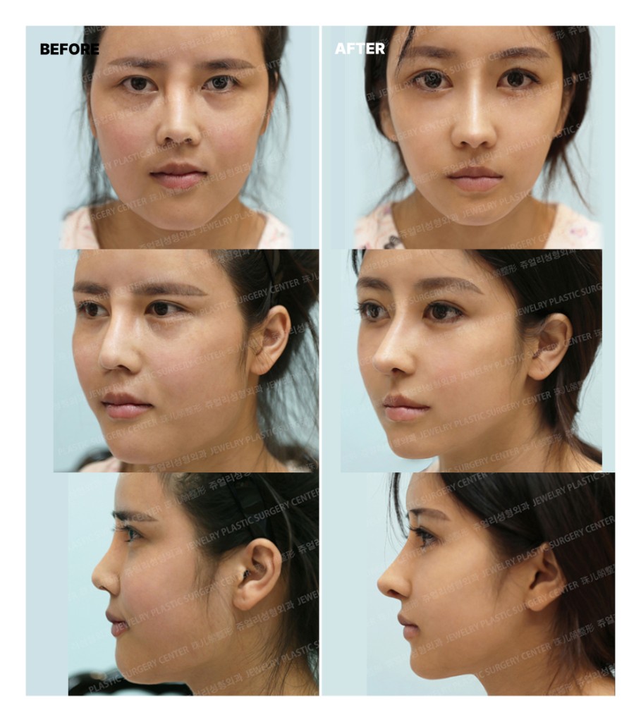 얼굴 윤곽 수술 전후 참고 이미지. 전·후 비교가 한 장에 포함되어 있습니다.
