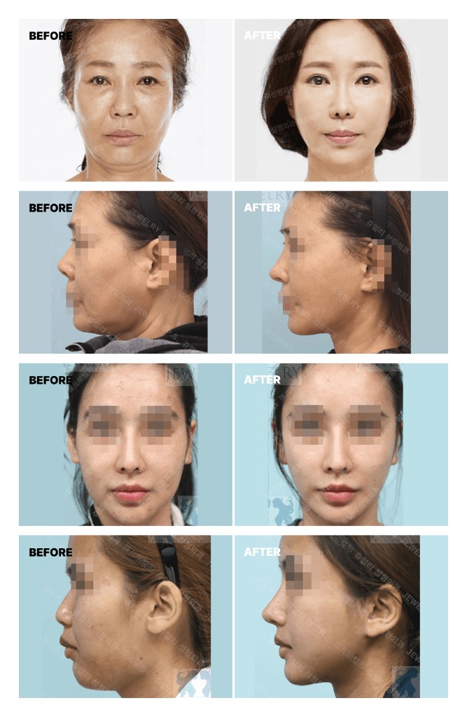리프트 전후 참고 이미지. 전·후 비교가 네 가지 사례로 포함되어 있습니다.