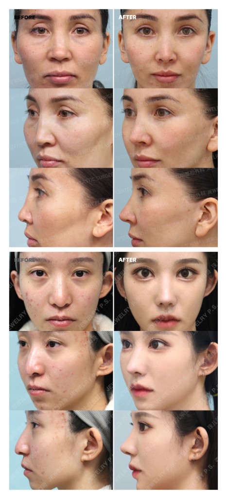 코 수술 전후 참고 이미지. 전·후 비교가 한 장에 포함되어 있습니다.