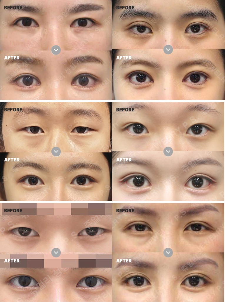 윤영일 대표원장 눈 성형 대표 수술 사례