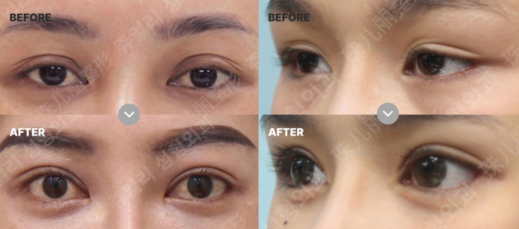 신영원 대표원장 눈 성형 대표 수술 사례