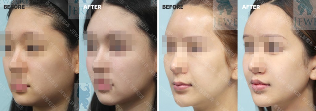 윤영일 대표원장 풀페이스 지방이식 대표 수술 사례